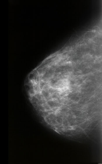 Mammográfia felvétel